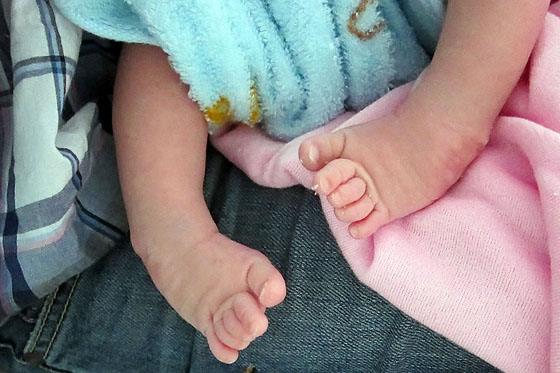 Clubfoot