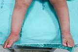 Ellie's feet after the first set of Dr Amnuay's casts - Click for larger image
