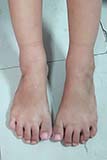 A five year old girl's feet after successful Ponseti method treatment - Click for larger image